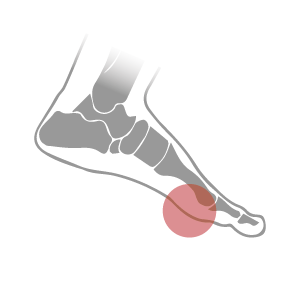 Pressure in the ball of the foot can be caused by flat feet or high arches. Custom arch support can help reduce this pressure, relieving pain in the ball of your foot.