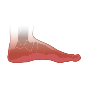  Step out of pain and back into life. Insoles with custom made arch and heel cup improves comfort and provides relief from various foot pathologies, flat feet, high arches, pronation, and supination.