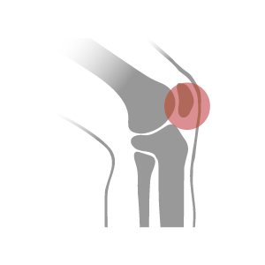 Knee pain is often caused by the misalignment of your joints and ligaments. Custom arch support helps to put your foot back into a naturally aligned position helping to promote better alignment throughout the entire body.