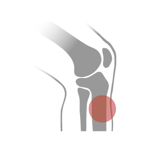 Say goodbye to your shin splints. Insoles with polyurethane plastic in the heel cup helps with shock absorption, while our semi-rigid material helps to redistribute the pressure that causes shin splints.